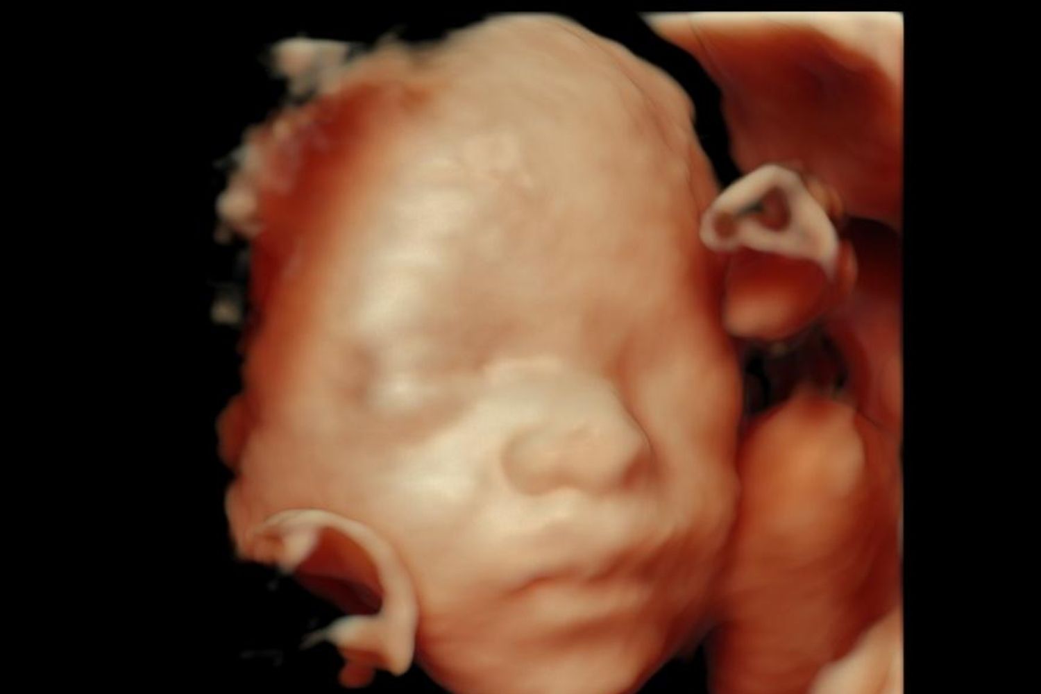 Ultrasonido 4D bebé - Voluson E10