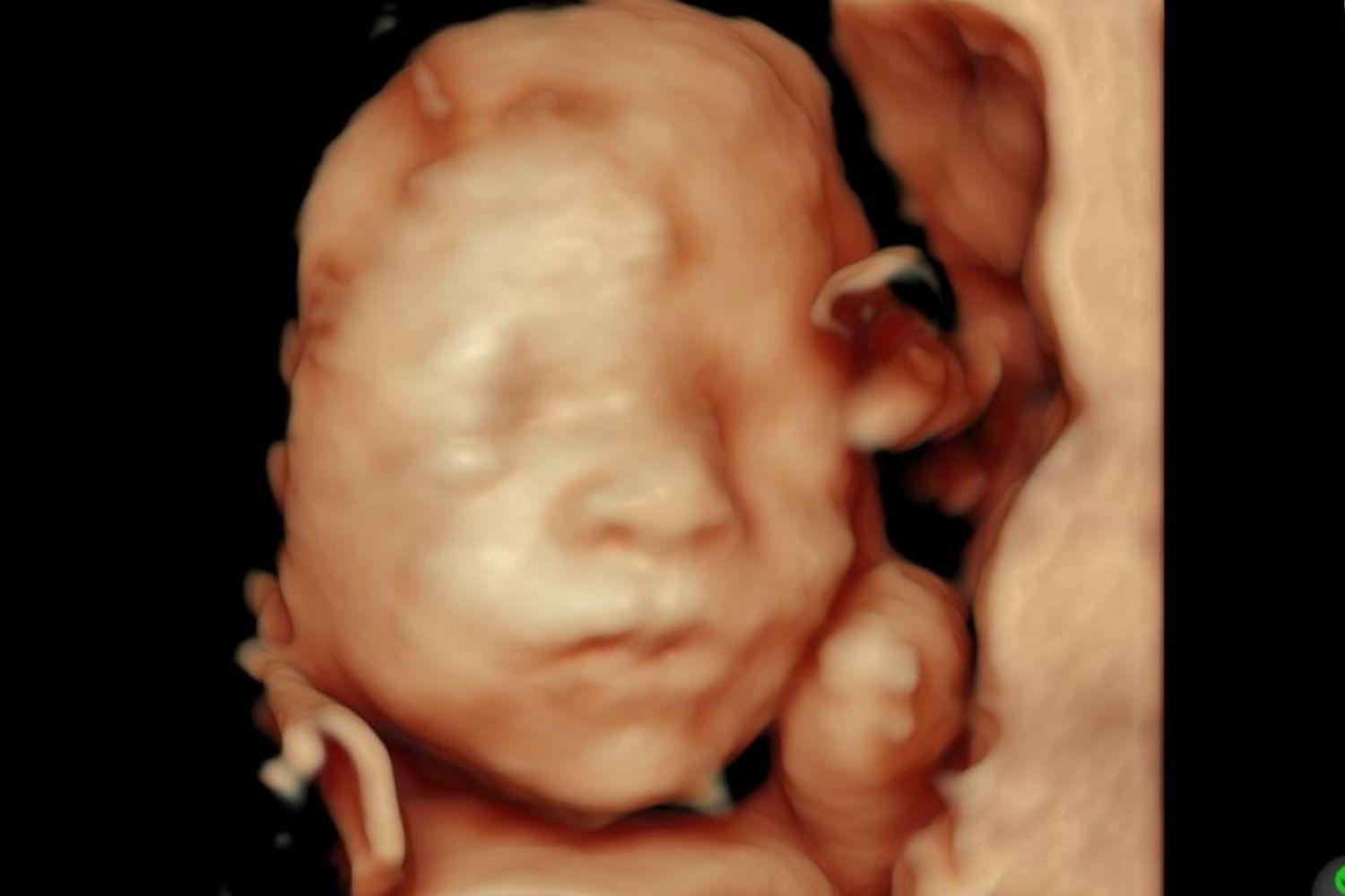 Ultrasonido 4D bebé perfil - Voluson E10